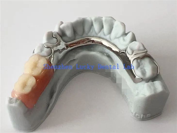 3D Print Kina Prilagođeni zubni metalni okvir sa akrilnom protezom
