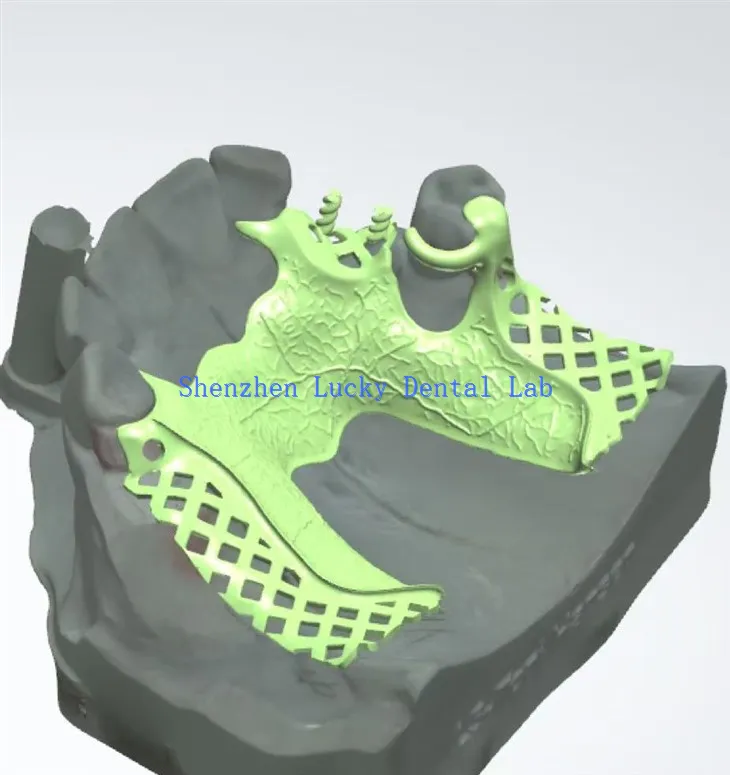 3D Print Zubni metalni proizvođači okvira