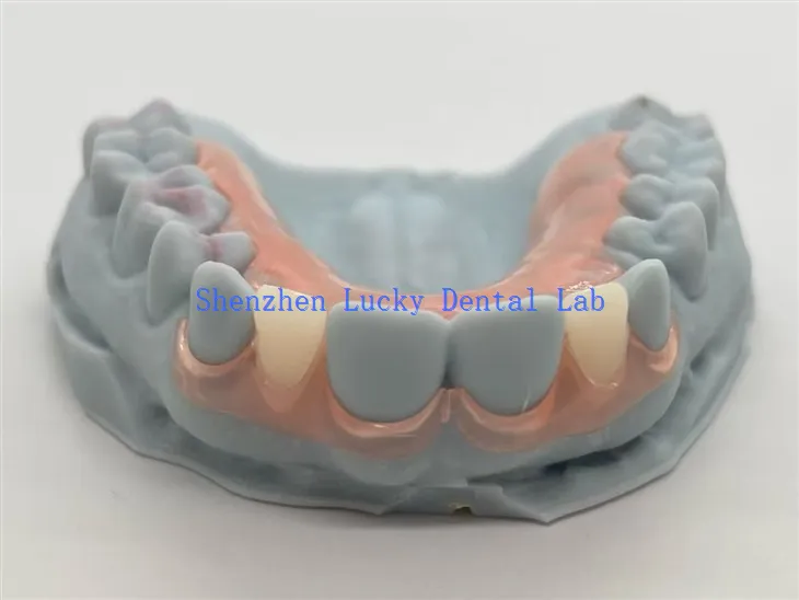 3D print Dental TCS Fleksibilne djelomične proteze