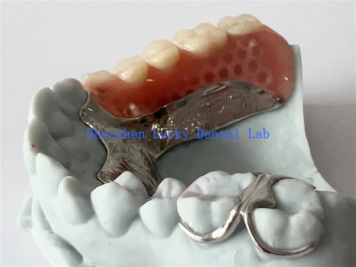 3D ispis jezični bar zubni metalni okvir sa dvostrukim aker kopčom