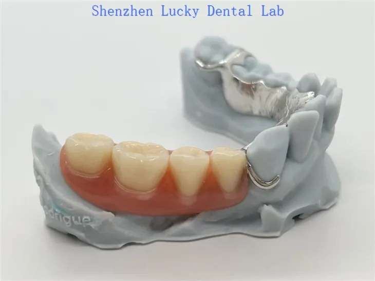 3D print metalni Co Cr okvir sa akrilnim protezama