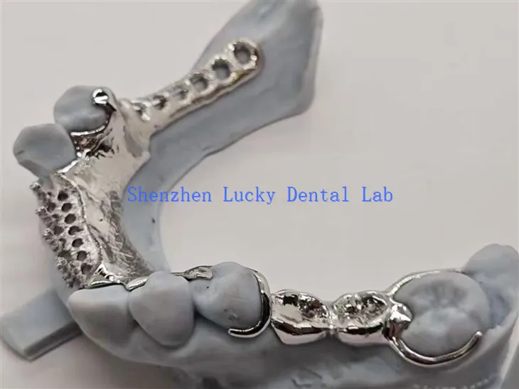 3D metalni okvir za ispis sa leguranim dizajnom zuba