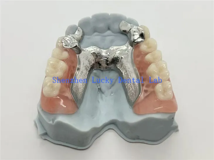 3D print metalna djelomična proteza s podlogom za zube od legure