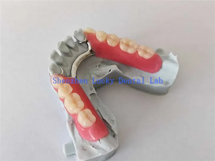 3D print Djelomična akrilna proteza sa metalnim okvirom pokušajte u zubnoj laboratoriji