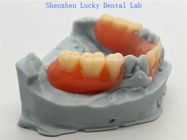 3D print uklonjiva akrilna proteza