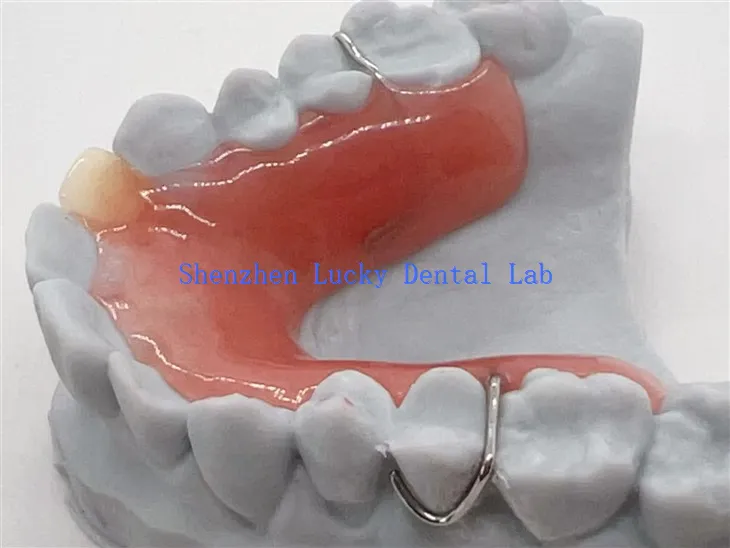 Djelomična proteza s 3D printom koja se može ukloniti s akrilnom bazom