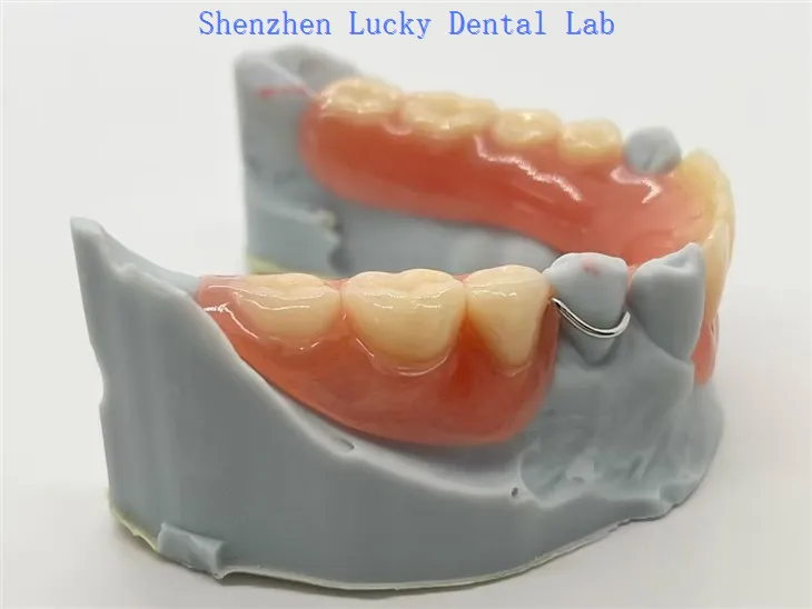 Akrilna uklonjiva djelomična proteza sa kopčom za žicu