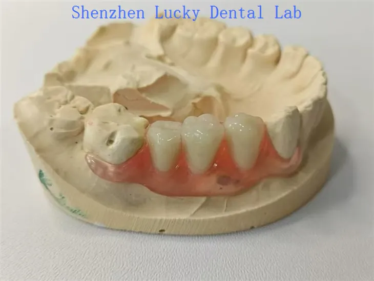 Estetski zubni valplast flipper