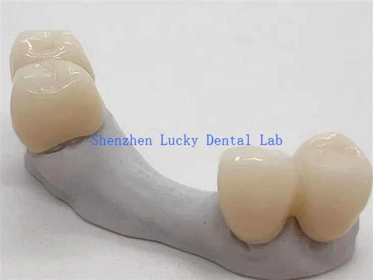 Estetski zubni cirkonijski most