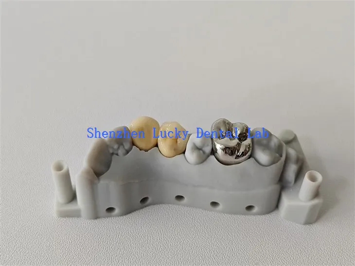 Estetski 3D print FMC i PFM Cocr Crown napravljen u Kini