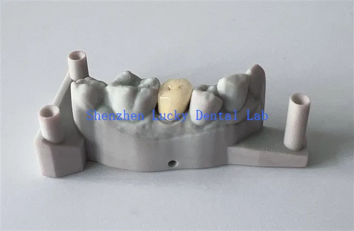 Pristupačan 3D print Dental PFM Cocr Crown Stomatološki laboratorij