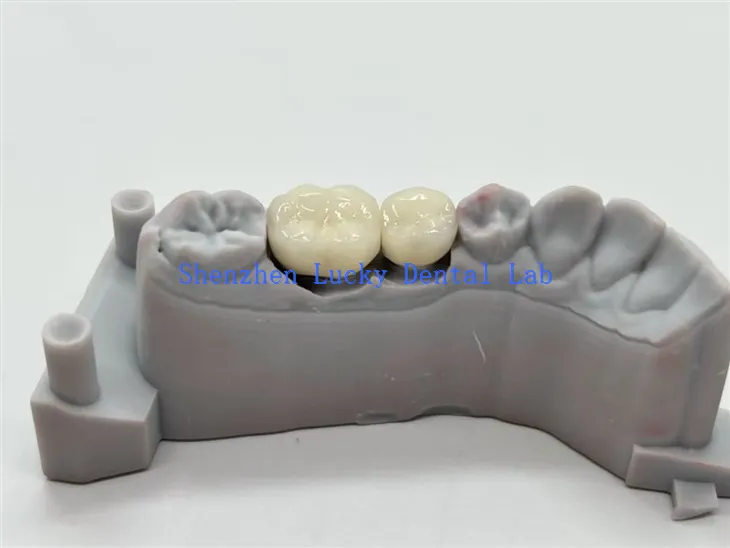 CoCr legura PFM zubne krunice