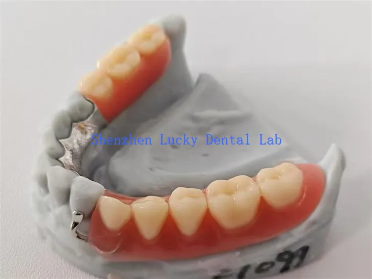 Prilagođena akrilna proteza sa jezičnim - pločastim metalnim okvirom zubne laboratorije