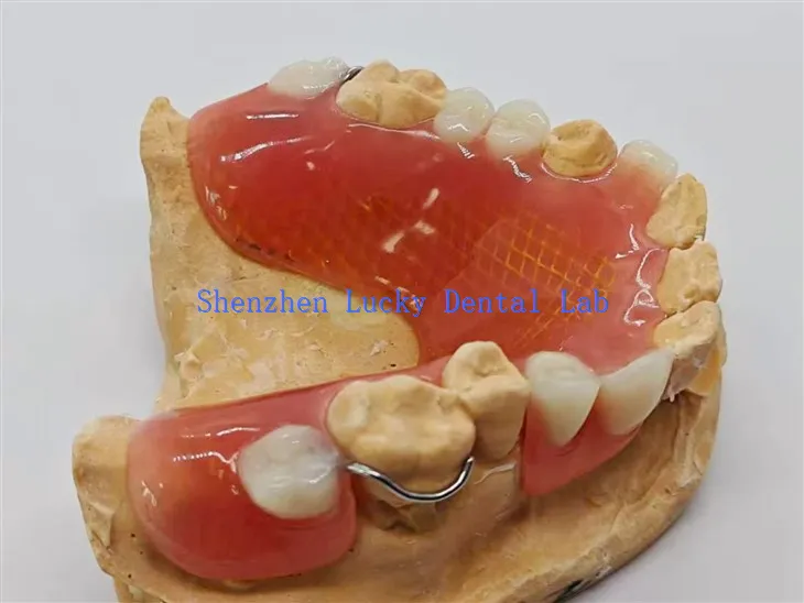 Izmjenjiva djelomična proteza sa metalnom mrežom