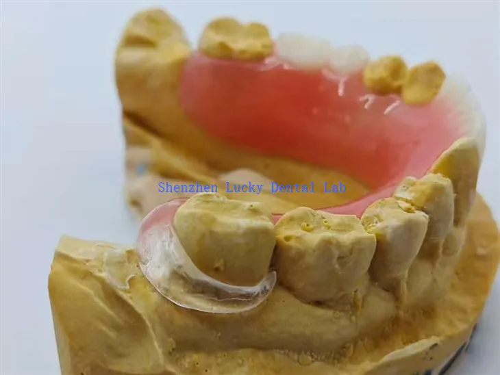 Akrilna proteza sa čistom kopčom