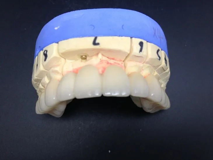 Visoko precizna zubna krunica od potpuno keramike od cirkonija