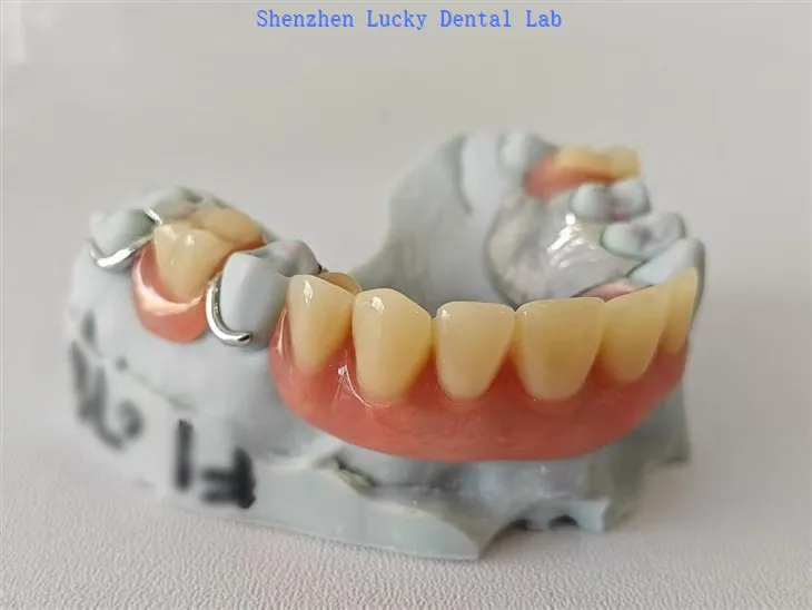 Djelomična akrilna proteza sa metalnim okvirom sa žičanom kopčom