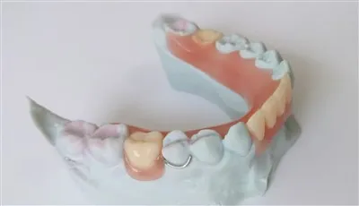 3D Print Stomatološka djelomična akrilna proteza sa kopčom za žicu