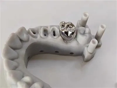 Kina visokokvalitetna zubna kruna metala