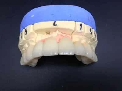 Visoko precizna zubna krunica od potpuno keramike od cirkonija