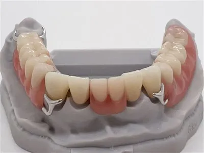 T-bar kopča akrilna proteza sa zubnim cirkonijom