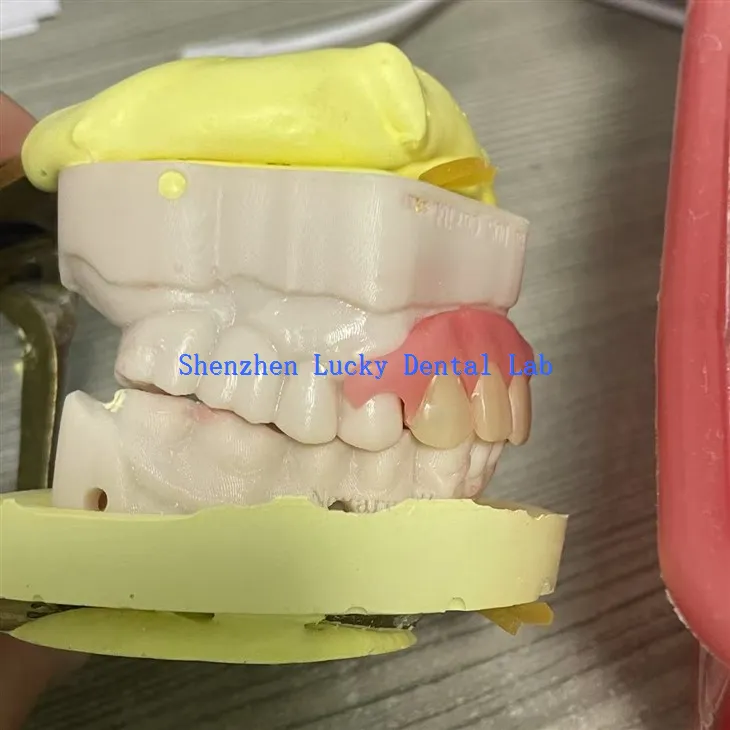 Udobna djelomična fleksibilna proteza pokušajte u stomatološkoj laboratoriji