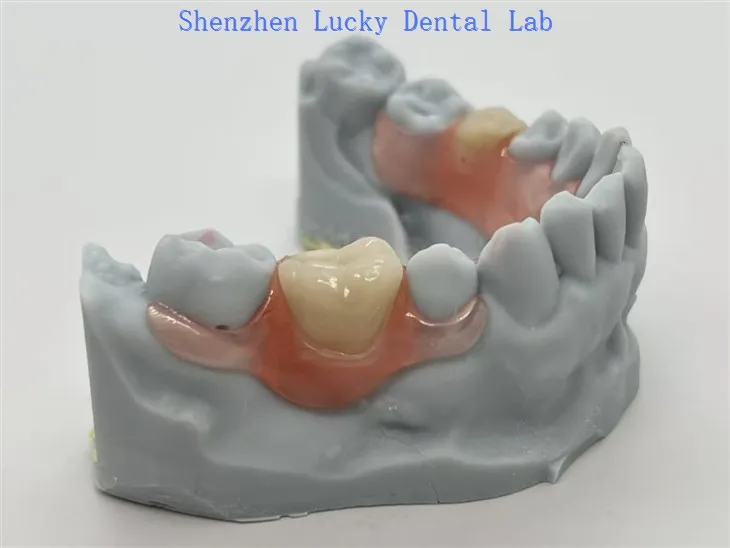 Valplast® partijali sa fleksibilnom kopčom