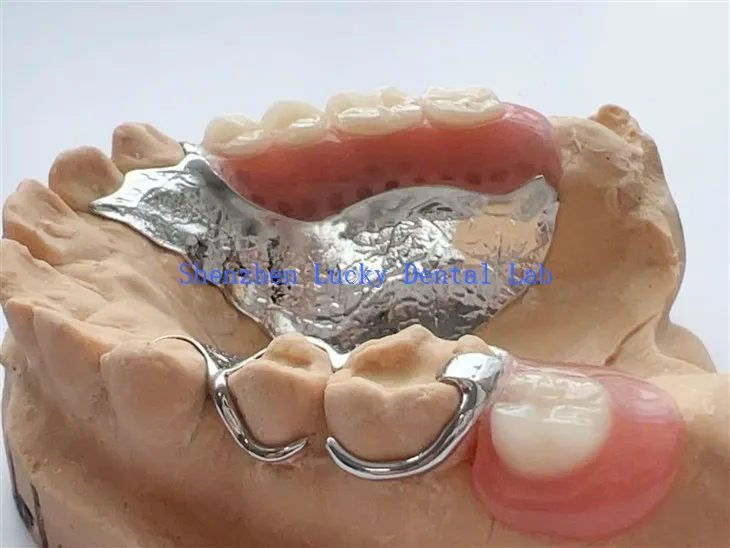 Zrakoplovni metalni okvir zubnih metala sa djelomičnom akrilnom protezom